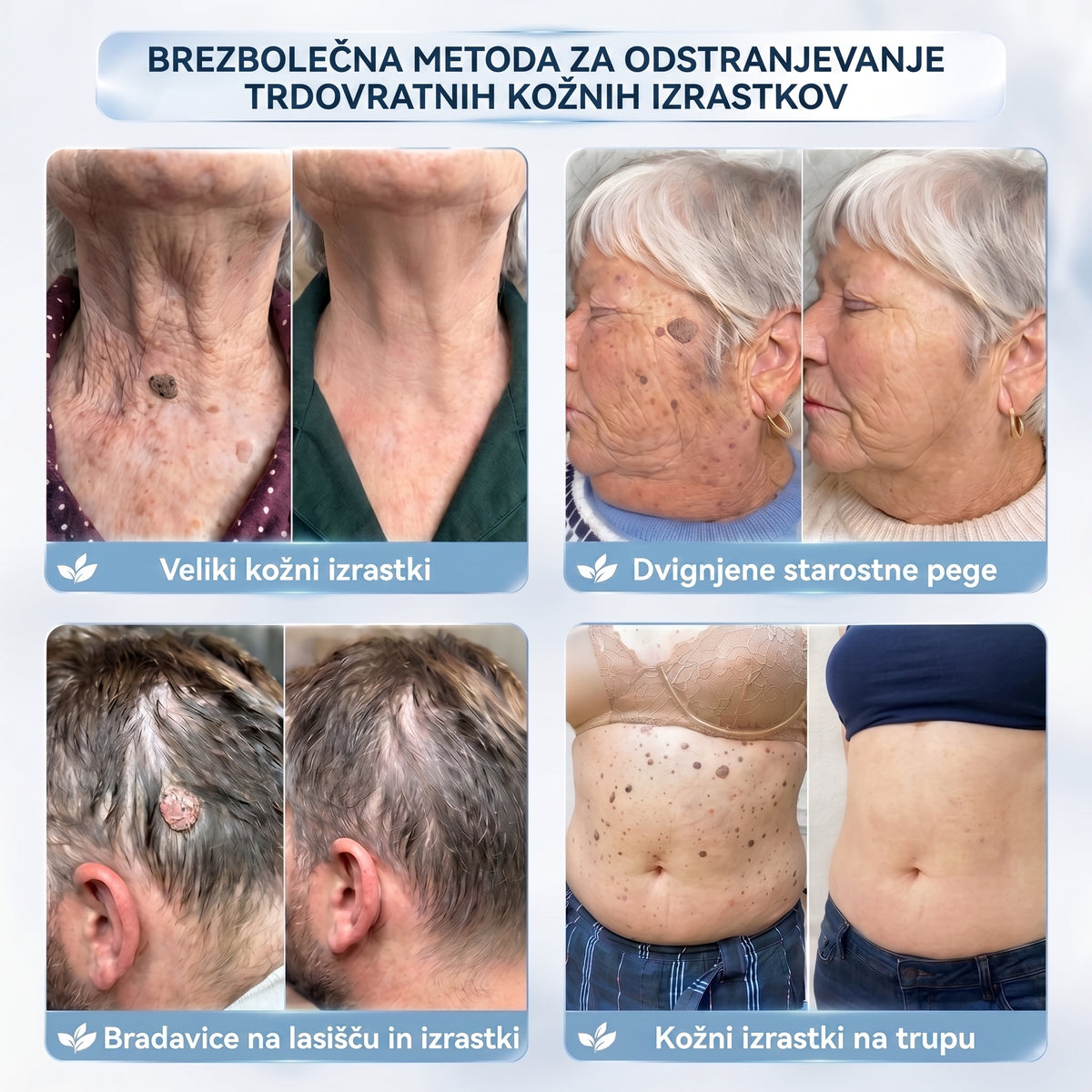 𝐇𝐢𝐬𝐤𝐢𝐧® 2-v-1 napredna negovalna krema za kožo – za nežno nego kožnih izrastkov, bradavic in vidnih kožnih nepravilnosti