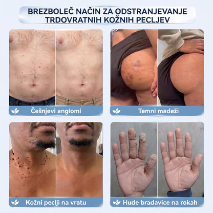 𝐇𝐢𝐬𝐤𝐢𝐧® 2-v-1 napredna negovalna krema za kožo – za nežno nego kožnih izrastkov, bradavic in vidnih kožnih nepravilnosti